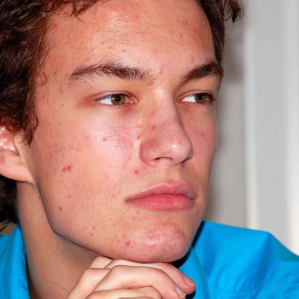 Mads Timmermann before using Danish Skin Care products, showing visible acne